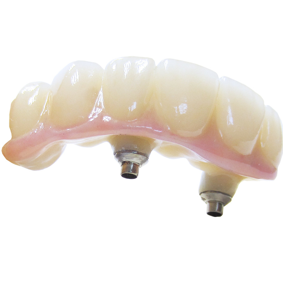 Céramique sur zirconium transvissée sur implant avec interface titane HR