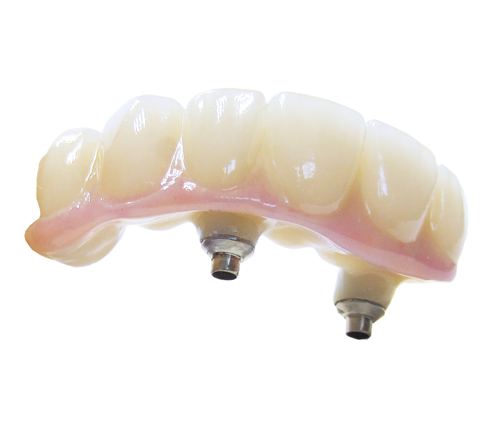 Céramique sur zirconium transvissée sur implant avec interface titane HR