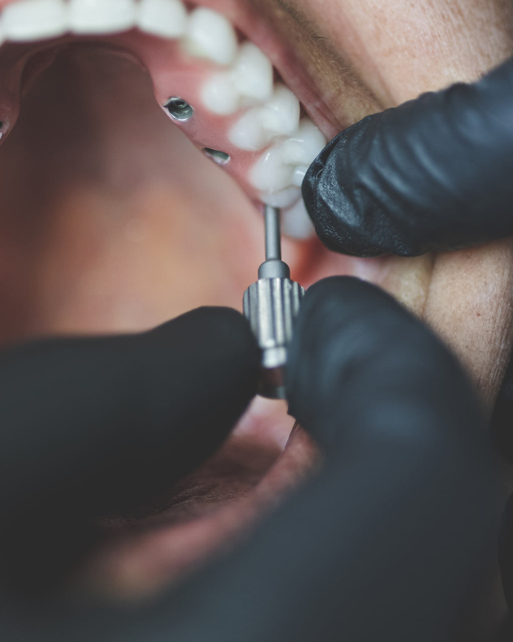 Prothèses-sur-implants-Protilab