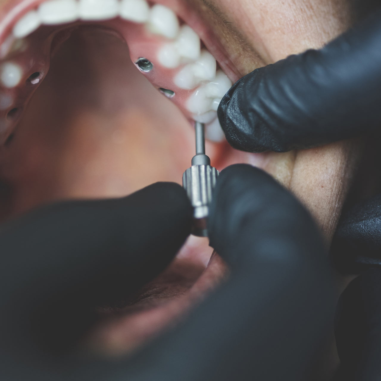 Prothèses-sur-implants-Protilab
