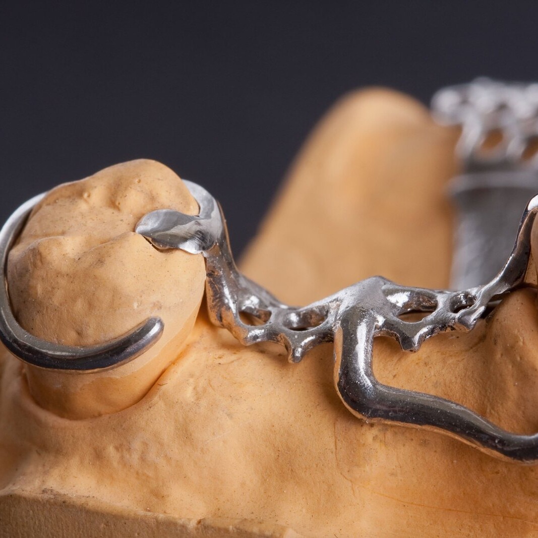 Metalen frameprothese op gipsmodel